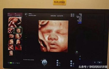 拍四维彩超让注意左肾情况,做四维彩超需要注意什么