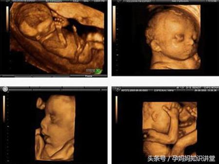 拍四维彩超让注意左肾情况,做四维彩超需要注意什么