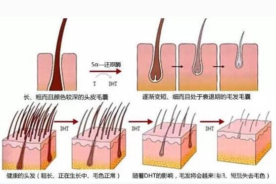 毛囊萎缩是怎样形成的,毛囊萎缩的前兆是什么