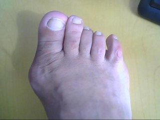 尿酸降下来了为什么痛风还会反复,尿酸降下来后能停服非布司他药吗