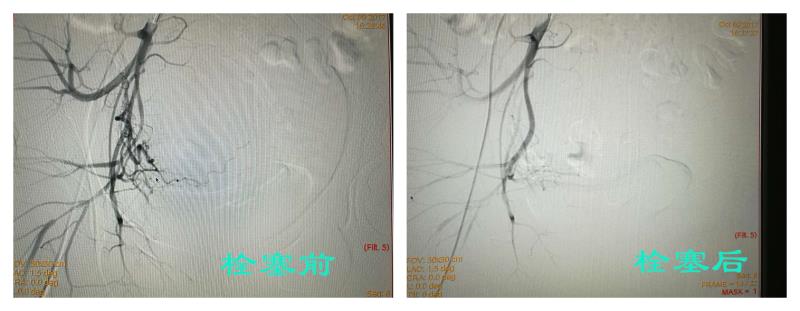 瘢痕妊娠大出血，巴彦淖尔市医院保命保子宫！