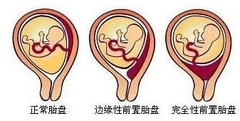 做完子宫肌瘤手术后千万别急着怀孕,小心子宫爆炸!