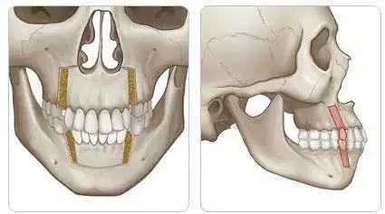 嘴突怎么治疗最有效,凸嘴快速改善方法