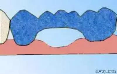 掉牙时强行拔牙弄下来会发生什么,拔牙以后真的会牙齿掉得快吗