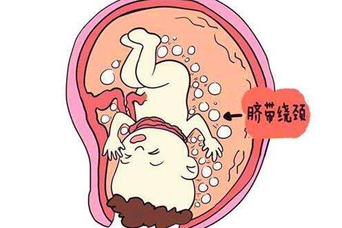 脐带绕颈和脐带绕腹哪个危险,怎么避免脐带绕颈