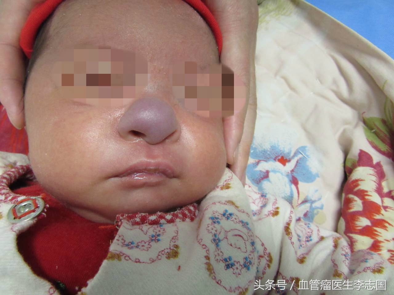 血管瘤治疗后肌肉萎缩怎么修复,血管瘤大面积治疗后皮肤恢复吗