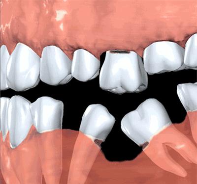 掉牙时强行拔牙弄下来会发生什么,拔牙以后真的会牙齿掉得快吗