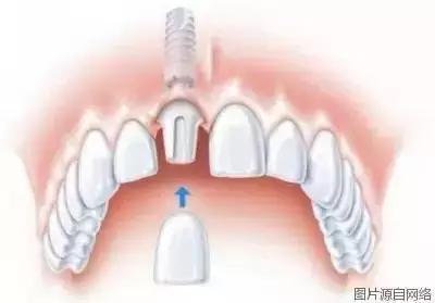 掉牙时强行拔牙弄下来会发生什么,拔牙以后真的会牙齿掉得快吗