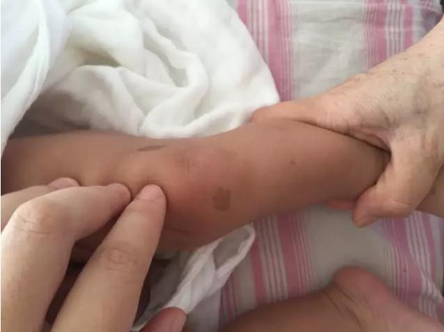 丢失孩子出生时脖子后面有胎记,婴儿出生胎记用不用去除