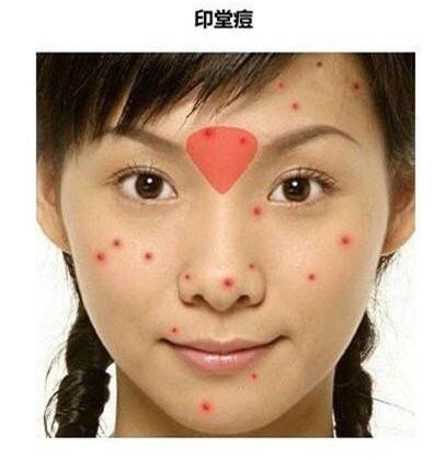 长痘真的影响颜值教你祛痘小妙招,祛痘小知识如何正确避免长痘