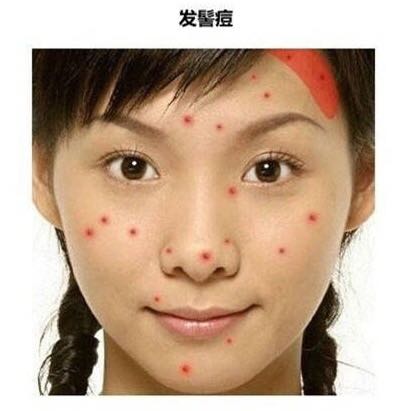 长痘真的影响颜值教你祛痘小妙招,祛痘小知识如何正确避免长痘