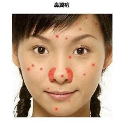 长痘真的影响颜值教你祛痘小妙招,祛痘小知识如何正确避免长痘