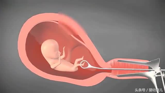人工流产的胎儿会变成什么样,人工流产的胎儿在肚子里什么样