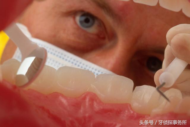 换牙前蛀牙有龋洞需要治疗吗,蛀牙形成需要多久