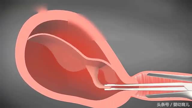 人工流产的胎儿会变成什么样,人工流产的胎儿在肚子里什么样