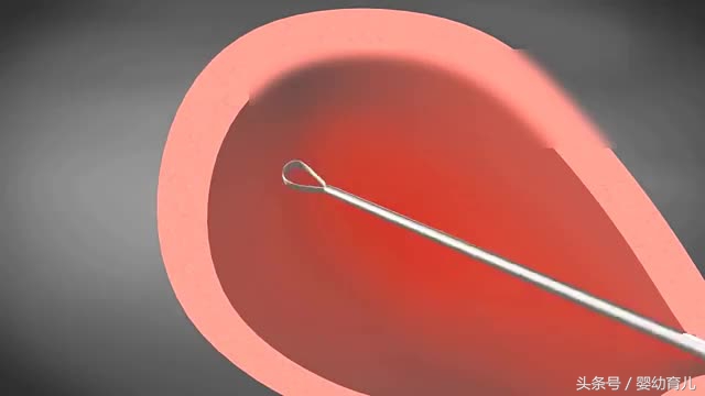 人工流产的胎儿会变成什么样,人工流产的胎儿在肚子里什么样