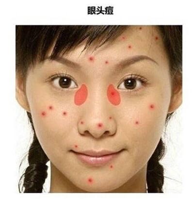 长痘真的影响颜值教你祛痘小妙招,祛痘小知识如何正确避免长痘