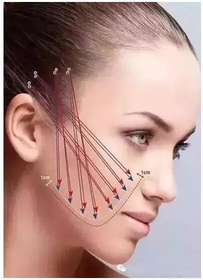 微整形一般几天消肿,微整形需要多久才能学