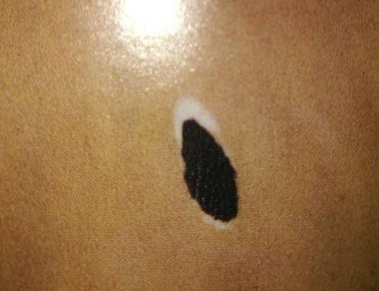 身上的黑痣什么情况下要去检查,身上的黑痣要不要去除