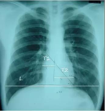 读完该文，让你学会如何看胸片