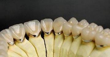 如何科学地选择烤瓷牙种类,护牙健齿的三大秘诀
