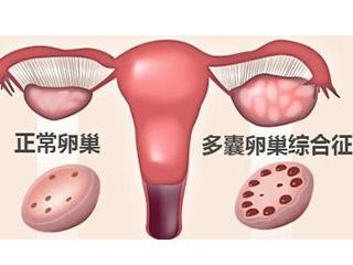 卵巢多囊综合症症状怎么治疗,多囊卵巢综合症皮肤有什么症状