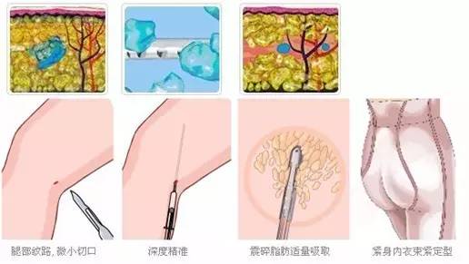吸脂减肥成本一般多少钱,吸脂减肥一般要花费多少钱