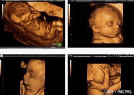 做四维彩超有什么注意事项,做四维彩超的注意事项是什么