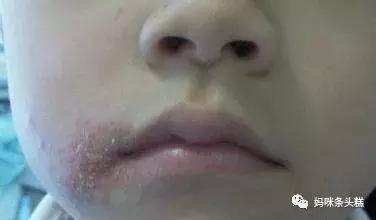 黄帝内经如何治疗眼袋,宝宝有黑眼圈没有食欲