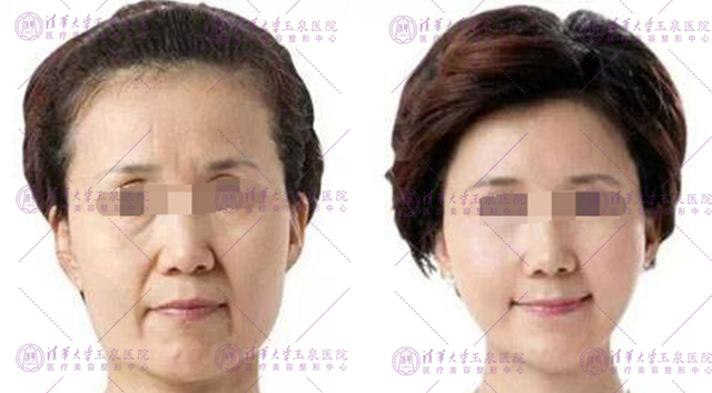 超声刀和热玛吉区别适合人群,热玛吉和超声刀该怎么选