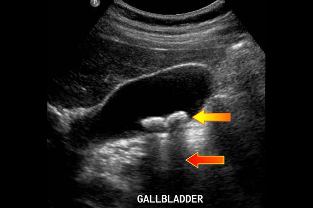 结石太大块体外碎石可以碎吗,得了结石用碎石可行吗
