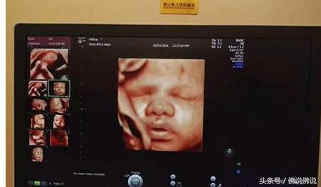 做四维彩超有什么注意事项,做四维彩超的注意事项是什么