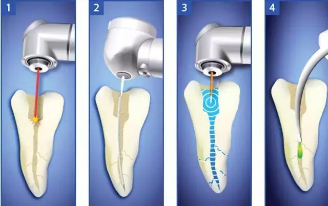 牙齿被判了死刑，就真的没救了