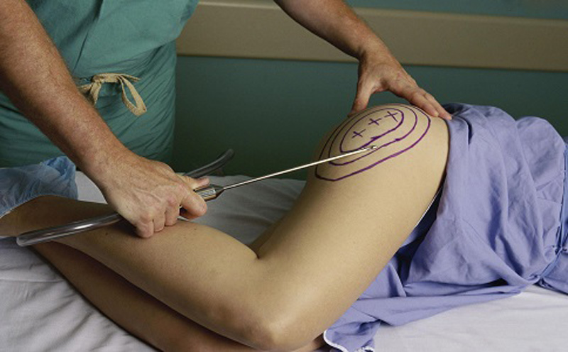 最先进的吸脂减肥,神乎其神减肥成功案例