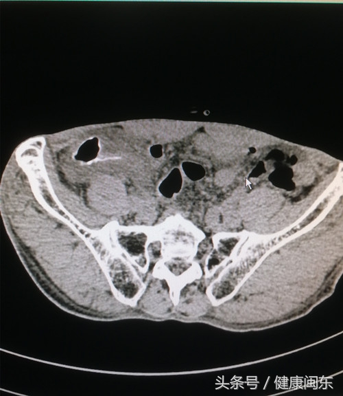 海边居民身体遭血吸虫卵寄居闽东医院医生揪住“元凶”