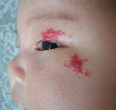 血管瘤好可怕,孕妈妈该怎么预防?