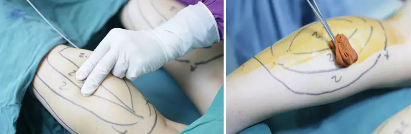 最先进的吸脂减肥,神乎其神减肥成功案例