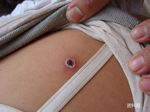 巨型毒虫有多可怕,南方咬人的毒虫有哪些