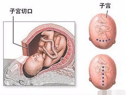剖腹产手术全过程图解，需要切开7层才能将宝宝取出