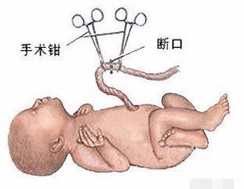 剖腹产手术全过程图解，需要切开7层才能将宝宝取出