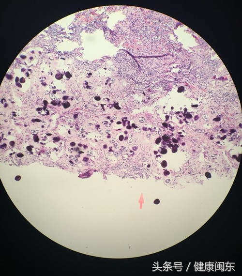 海边居民身体遭血吸虫卵寄居闽东医院医生揪住“元凶”