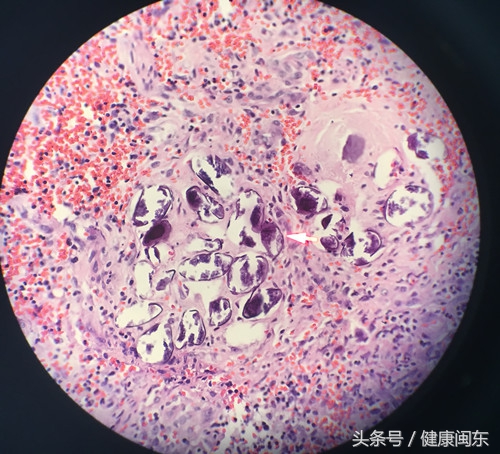 海边居民身体遭血吸虫卵寄居闽东医院医生揪住“元凶”