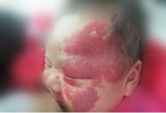 血管瘤好可怕,孕妈妈该怎么预防?