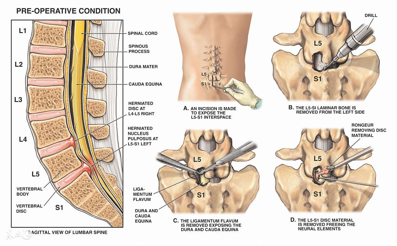 走路锻炼可以缓解腰椎间盘突出吗,腰椎间盘突出吊单杠正确锻炼方法