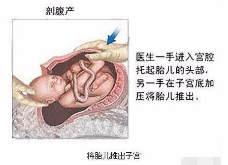 剖腹产手术全过程图解，需要切开7层才能将宝宝取出