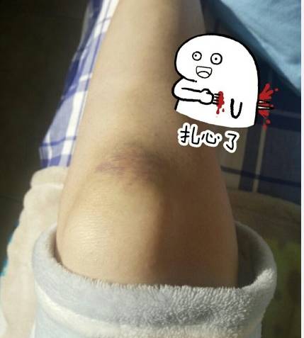 膝盖撞到硬物超级疼,膝盖经常撞地