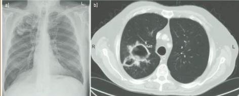 《慢性肺曲霉病:诊断和治疗的理论基础及临床指南》解读