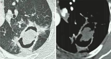 《慢性肺曲霉病:诊断和治疗的理论基础及临床指南》解读