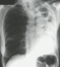 《慢性肺曲霉病:诊断和治疗的理论基础及临床指南》解读