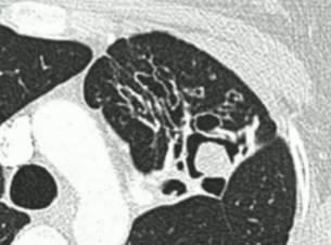 《慢性肺曲霉病:诊断和治疗的理论基础及临床指南》解读